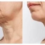 Neck Lift