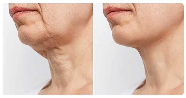 Neck Lift
